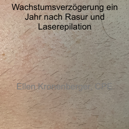 Wachstumsverzögerung ein Jahr nach der letzten Rasur und Laserepilation